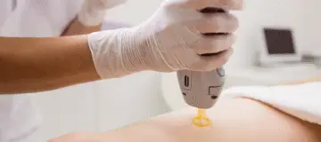 Zye Alx®: effectieve laserbehandeling voor haar, pigment en acne.